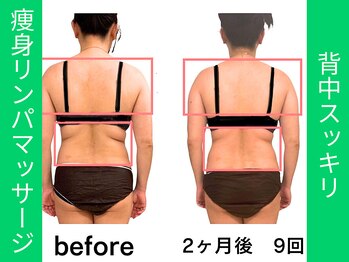 ミモザ鍼サロン(mimoza鍼サロン)/ラジオ波リンパケア♪