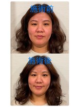 ふわふわり/フェイシャルのビフォーアフター