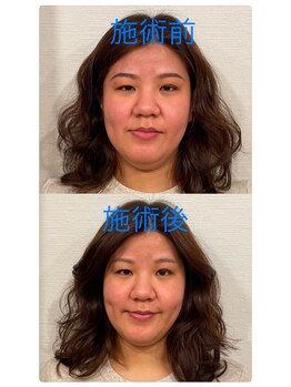 ふわふわり/フェイシャルのビフォーアフター