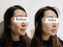 フラット(flat)/小顔とセルキュアで相乗効果◎