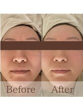 凪眠/小顔リンパフェイシャルの効果11