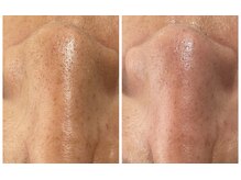 ソアン(Soin)/ハイドラフェイシャル