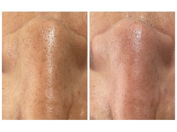 ソアン(Soin)/ハイドラフェイシャル