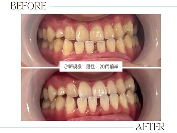 ホワイトニングサロンブライト 尼崎店(Whitening salon bright)/ご新規様のbefore/after