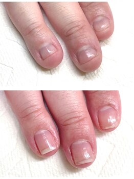 ティアラ(Tiara)の写真/【最強のネイルケアメソッド】深爪・二枚爪・平らな爪・乾燥などのお悩みを解消し縦長の美しい爪を育てる☆