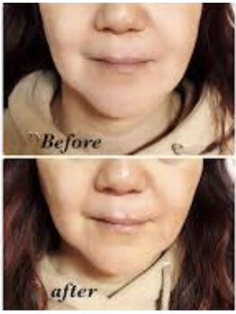 チャンティック (CANTIK)/小顔効果 EMSマッサージ