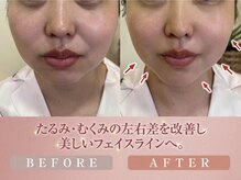 ステラグランデ(Stella grande)の雰囲気（小顔Wコルギで、フェイスライン/左右差/むくみ・たるみを改善☆）