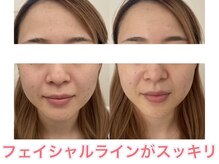 サクラ(SAKURA)/20代にはエアバリが大人気◎