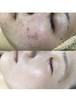 エヌエー(na)/乾燥肌・敏感肌・妊娠中も施術◎