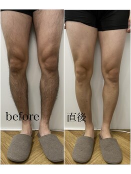 ゼロミリメートル(0mm)/【脱毛】ビフォーアフター