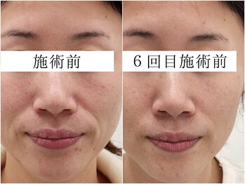 サロンドモフィ(salon de moffy)/美肌【エクソリフト】施術例２