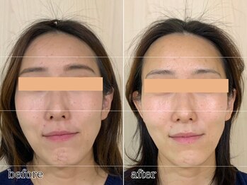 エビアス(Evias)/たった1回で見違える小顔に