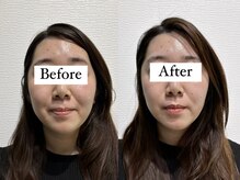 フラット(flat)/小顔とセルキュアで相乗効果◎