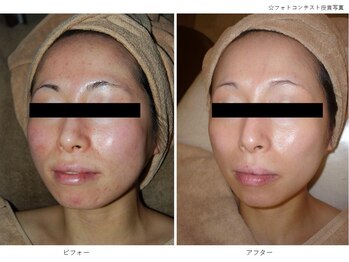 ベルメイク(BELLE MAKE)/水光ピール☆ビフォーアフター