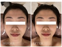 シュシュ(chouchou)/たるみもスッキリ