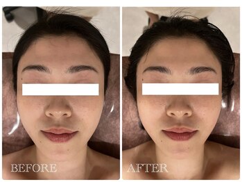 シュシュ(chouchou)/たるみもスッキリ