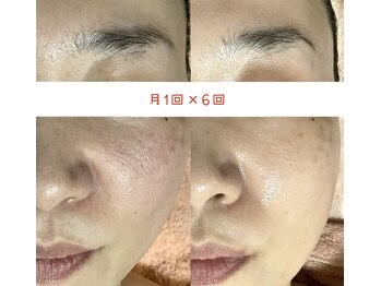 サロン ド グレイシャス エステティック(Salon de GRACIOUS esthetic)/光フェイシャル