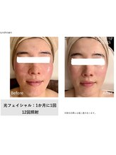 アトリア(ATRIA)/光フェイシャル＋専用フィルター