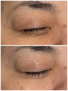 ミラヴィエ(Miravie)/目の下のたるみ引き締め一回