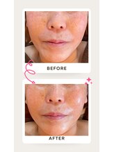 ナオフクオカ ヒーリングフォースエヌ(NaoFukuoka/healingforceN)/70代　小顔コルギでリフトアップ