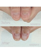 サロンペペ(salon pepe)/育成３カ月いつも深爪だった親指