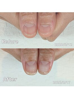 サロンペペ(salon pepe)/育成3カ月いつも深爪だった親指