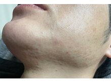 ラ ミジュ(La miige)/メンズ髭Wax