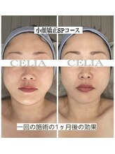 セリア(CELIA)/小顔矯正　