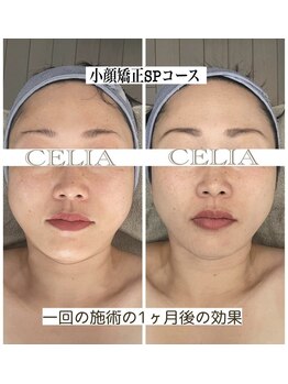 セリア(CELIA)/小顔矯正　