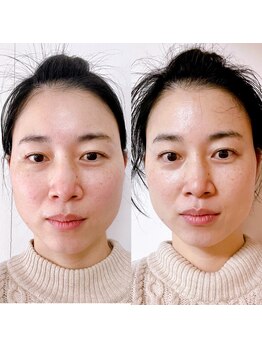 ミロクの里鍼灸院 東長崎店/【1回での変化】