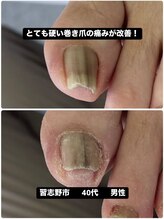 巻き爪じゅん 千葉駅前店/巻き爪の痛み当院の施術で改善