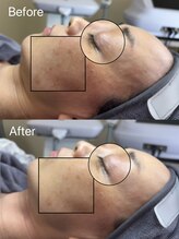 リル(Rire)/アクアダーマ/サーマトリックス