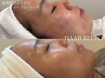 シェア(share.)/HAAB REPRO ハーブピーリング