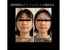 マシュマロヘッド 目黒店(Mashumaro Head)/深層顔筋フェイシャル