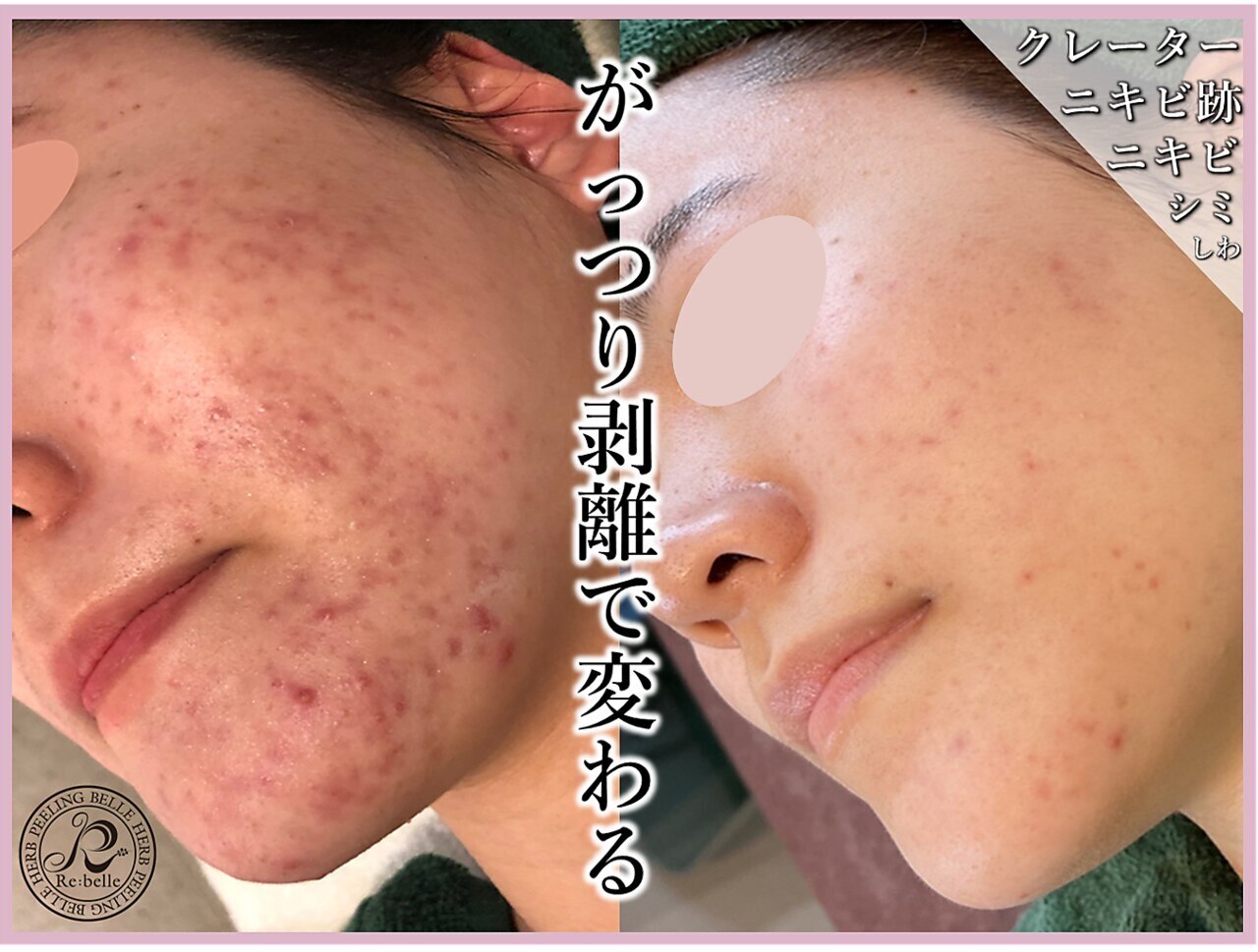 ハーブピーリング 剥離ありに関するエステサロン 美肌ケアサロンiru