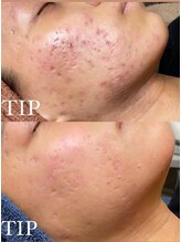 プランス 恵比寿店(PLANCE)/恵比寿エステ/エイジングケア