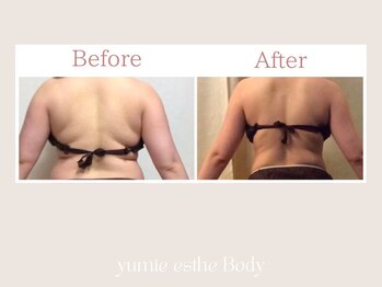 トータルビューティー ゆみえエステ(Total Beauty)/痩身/ハイパーナイフ ボディ