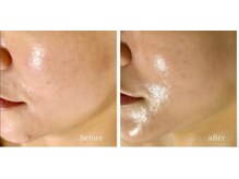 リュミエール(umiere)/小顔、リフトアップ