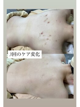 スキンプローズ(skinprose)/背中ハーブピーリング・ハード