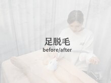 ボス 桑名店(BOSS)/足脱毛(before&after)