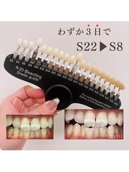 ブリエ(BRILLER)/《医》高効果ホワイトニング症例