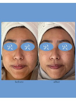 リスキン(Reskin)/ララピールでハリツヤ、美白！！