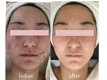 トリートメントルーム フェリーチェ(Felice)/手強い繰り返す大人ニキビに