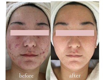 トリートメントルーム フェリーチェ(Felice)/手強い繰り返す大人ニキビに