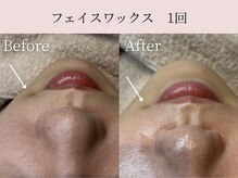 ミア(miiia)/フェイスワックス　1回