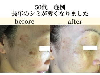 パールホワイトニング/輪郭のあるシミ改善◎