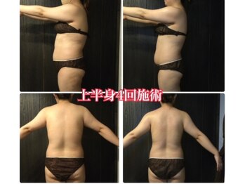 ジャスミン(Jasmine)/背中も変われる！！