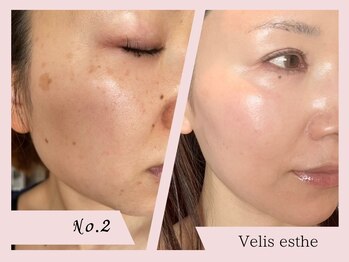 ヘアーアンドエステティック ヴェリス(hair&esthetic Velis)/当店エステ改善症例 No.2