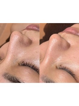 毛穴ケアをしたい