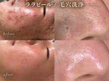 タイズレリーフ(TIES RELIEF)
